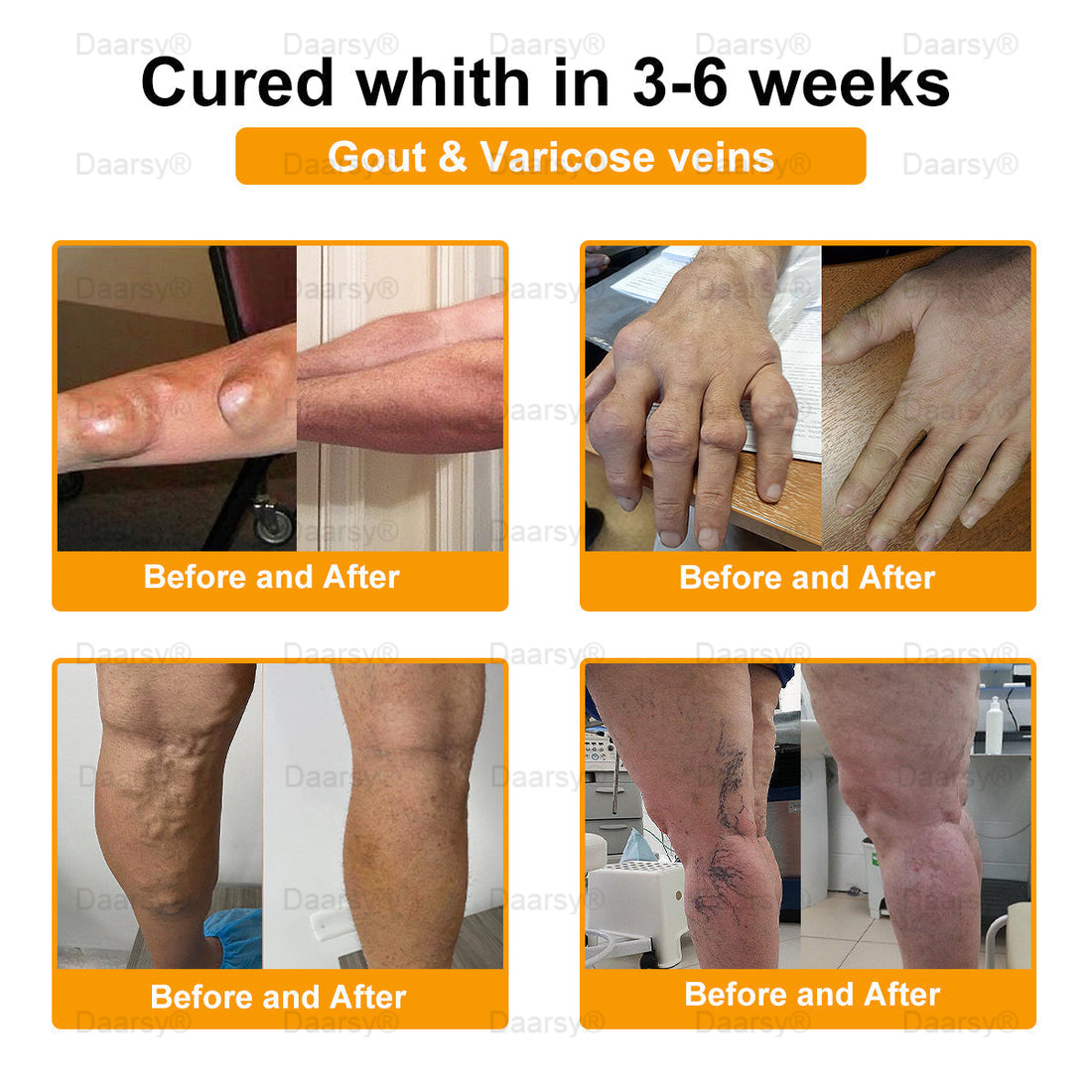 AAOS Official: Daasry™ Botulinum Toxin & Bee Venom Pain-Relief Bone Healing Cream