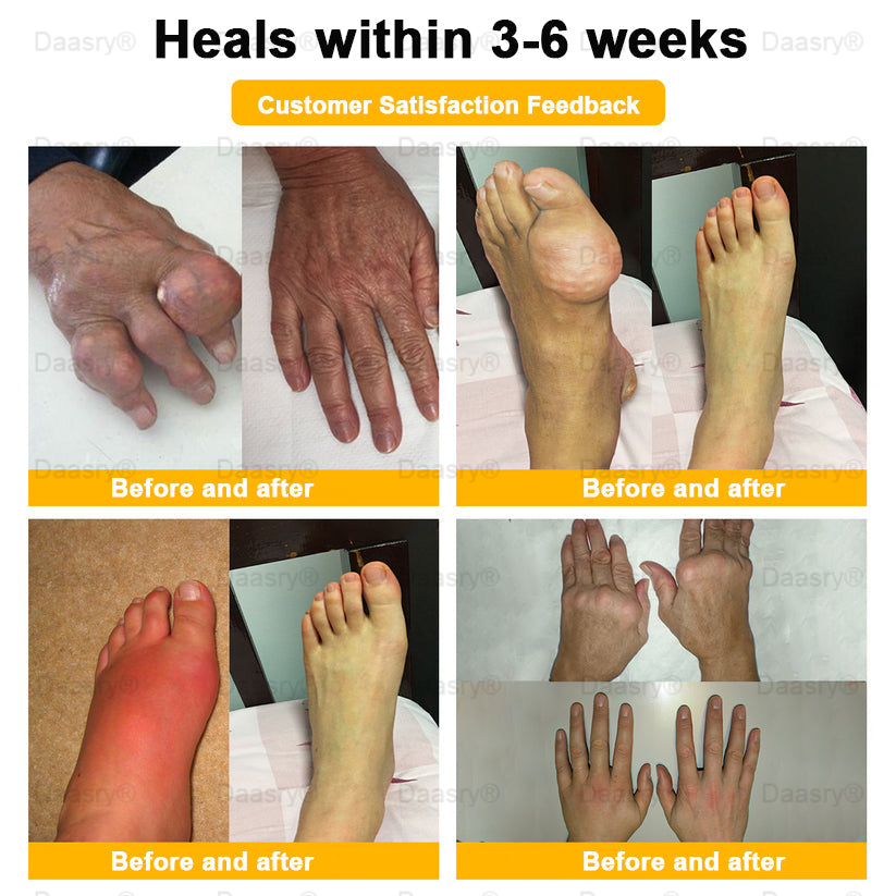 AAOS Official: Daasry™ Botulinum Toxin & Bee Venom Pain-Relief Bone Healing Cream