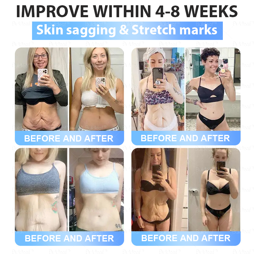 ✨👑CA Clinically Proven|Official Store |Buildleaf® Tirzepatide Slimming & Health Nano Microneedle Patch with Collagen & Matrixyl 3000丨Targets Obesity, Loose Skin, High Blood Pressure, Diabetes, Fatty Liver, Joint Pain, Brain Fog, Low Energy and More