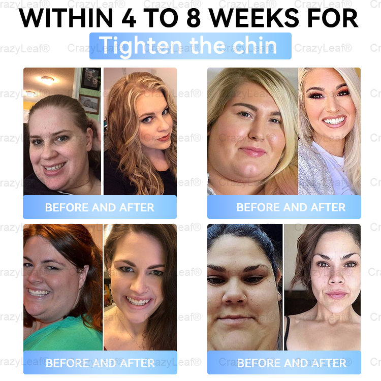 ✨👑CA Clinically Proven|Official Store |Buildleaf® Tirzepatide Slimming & Health Nano Microneedle Patch with Collagen & Matrixyl 3000丨Targets Obesity, Loose Skin, High Blood Pressure, Diabetes, Fatty Liver, Joint Pain, Brain Fog, Low Energy and More