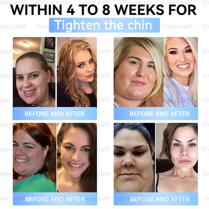 ✨👑CA Clinically Proven|Official Store |Buildleaf® Tirzepatide Slimming & Health Nano Microneedle Patch with Collagen & Matrixyl 3000丨Targets Obesity, Loose Skin, High Blood Pressure, Diabetes, Fatty Liver, Joint Pain, Brain Fog, Low Energy and More
