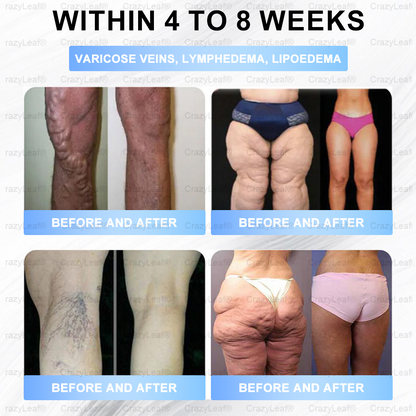 ✨👑CA Clinically Proven|Official Store |Buildleaf® Tirzepatide Slimming & Health Nano Microneedle Patch with Collagen & Matrixyl 3000丨Targets Obesity, Loose Skin, High Blood Pressure, Diabetes, Fatty Liver, Joint Pain, Brain Fog, Low Energy and More